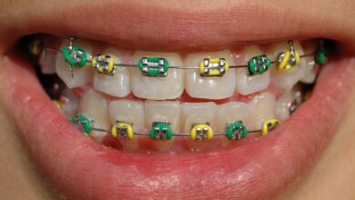 Diş teli tedavisi nasıl yapılır? Tedavi sırasında nelere dikkat edilmeli?